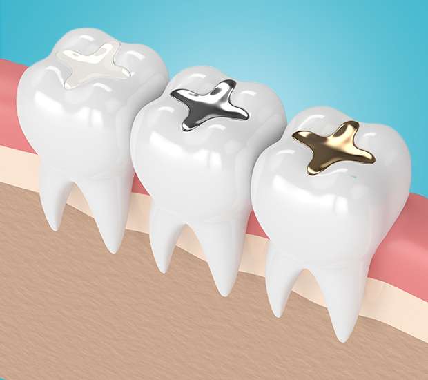 Fort Worth Composite Fillings